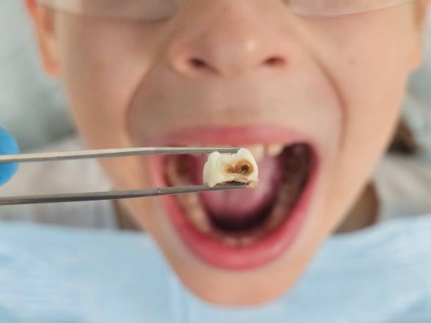 Best Emergency Tooth Extraction  in Quinebaug, CT